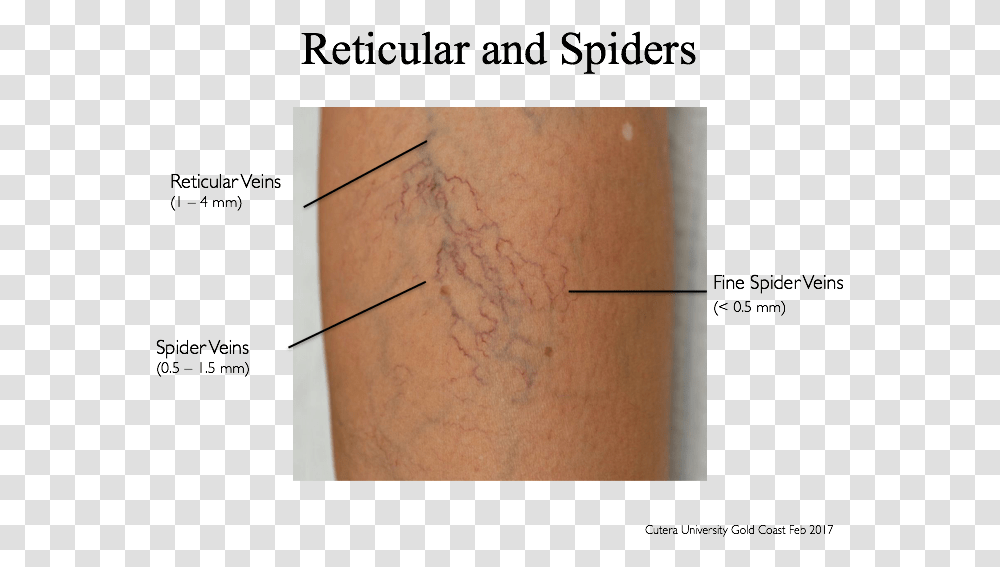 What Not To Treat Hits The Spot Spider Vein Treatment Cutera, Skin, Knee, Arm, Shoulder Transparent Png