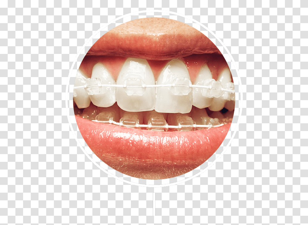 White And Silver Braces, Teeth, Mouth, Lip, Jaw Transparent Png