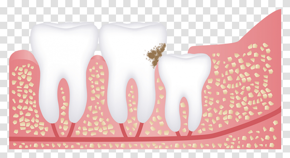 Wisdom Tooth Tooth Decay My Wisdom Tooth Hurting, Teeth, Mouth, Lip, Cushion Transparent Png