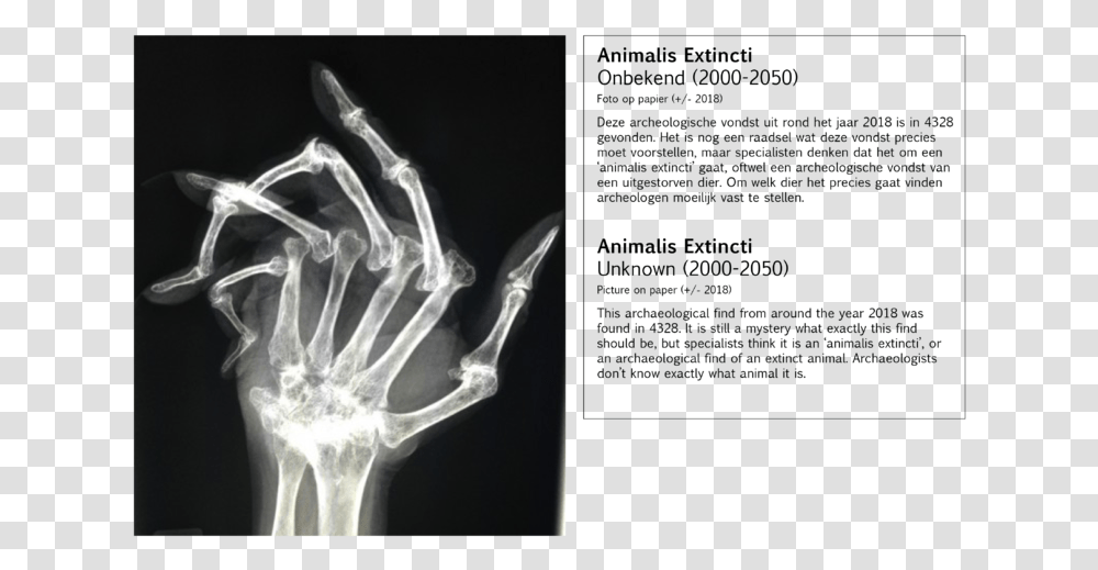 Worst Hand X Ray, X-Ray, Ct Scan, Medical Imaging X-Ray Film Transparent Png