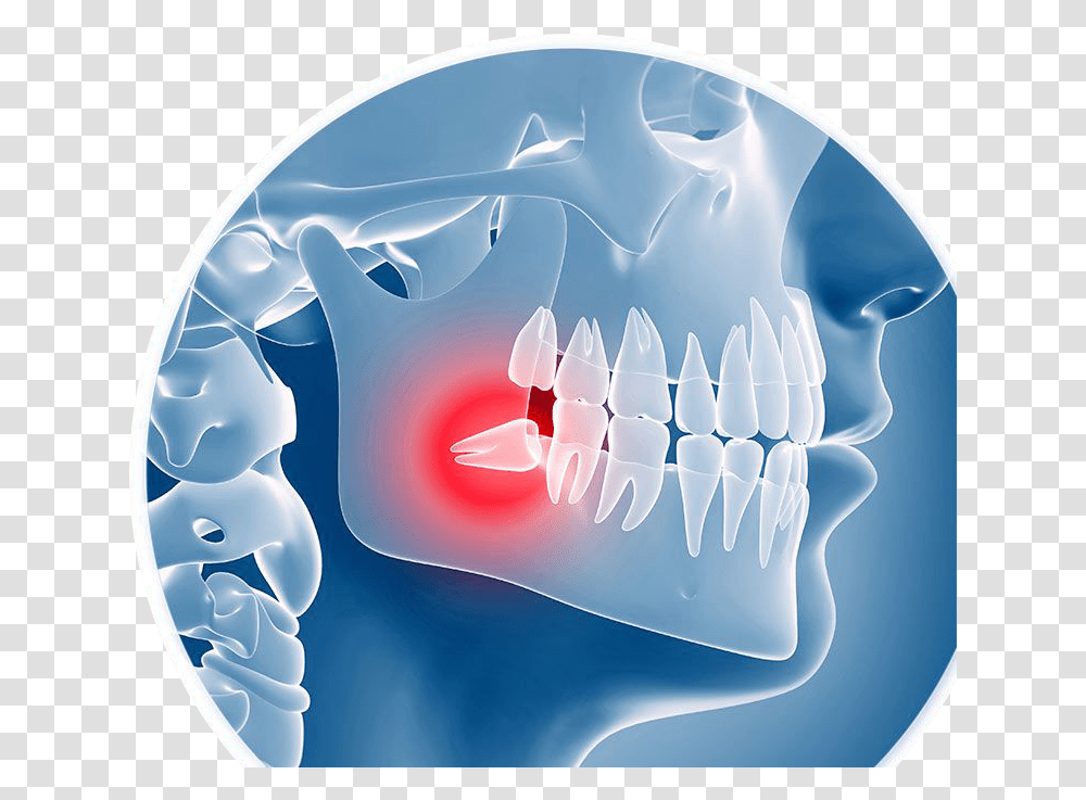 X Ray Illustration Of An Impacted Wisdom Tooth Wisdom Teeth Removal, Mouth, Lip, Birthday Cake, Dessert Transparent Png